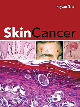 SKIN CANCER